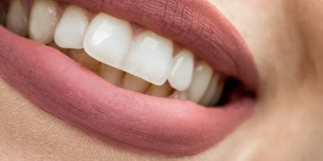 Jonathan Alexander Abt: Factors to Consider Prior to Undergoing Teeth Straightening